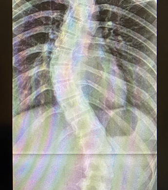 X-ray showing a case of scoliosis